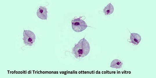 Infezione da trichomonas vaginalis