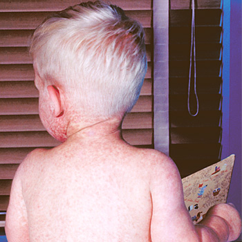 immagine di un bambino con il morbillo